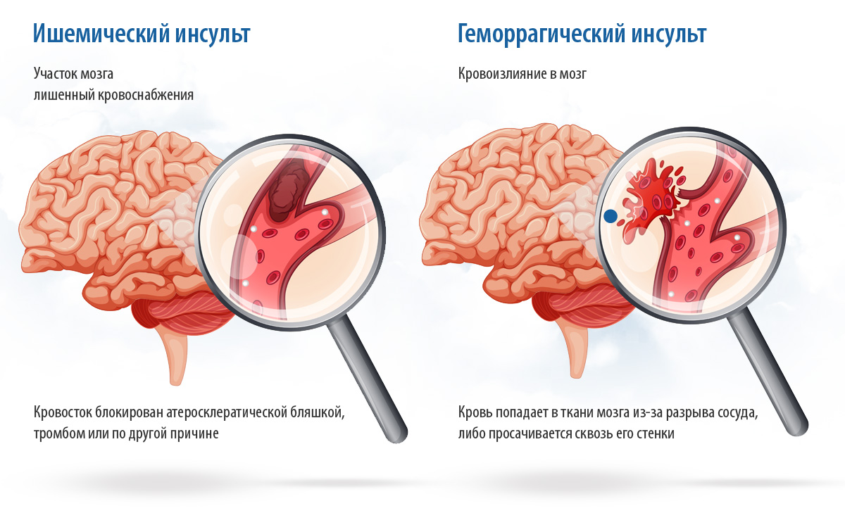 Виды инсульта